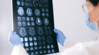 Brain Bypass Surgery STA-MCA